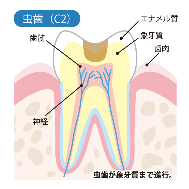 小宮歯科医院｜薬園台（船橋市）の歯医者、小宮歯科医院の精密むし歯治療