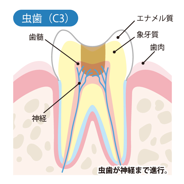 小宮歯科医院｜薬園台（船橋市）の歯医者、小宮歯科医院の精密むし歯治療