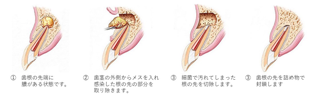 小宮歯科医院｜薬園台（船橋市）の歯医者、小宮歯科医院の精密根管治療